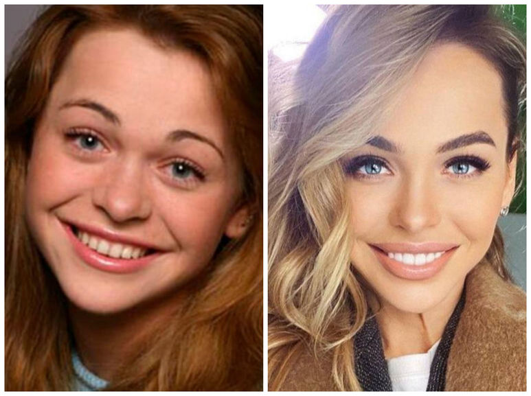 Анна хилькевич фото до и после пластики лица